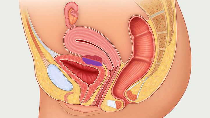endometriosis treatment in faridabad
