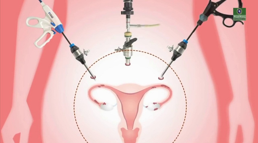 Hysterectomy treatment in faridabad