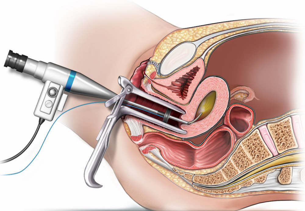 Hysteroscopy treatment in faridabad