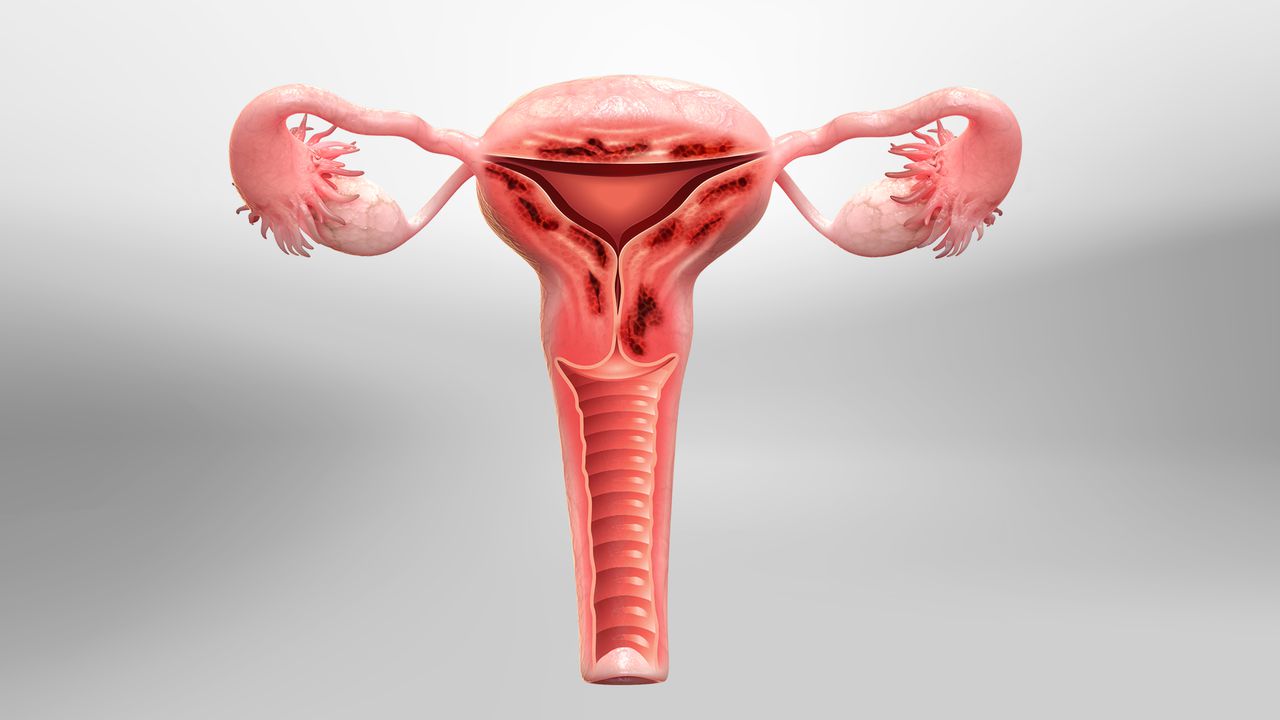 uterine fibroid treatment in faridabad